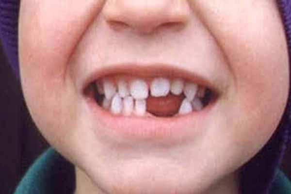 predict Broken tooth ฝันว่าฟันหัก เลขเด็ดออนไลน์
